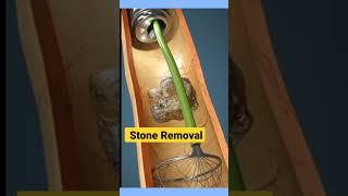 3D Key Hole Stone Removal | #kidneystone #kidneystonetreatment #3danimation #shorts #ytshorts #stone