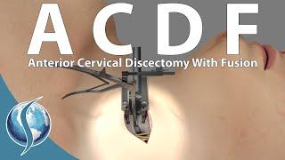 Anterior Cervical Discectomy and Fusion