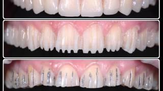 esthetic rehabilitation with ceramic veneers