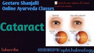 Cataract by Geetaru #ophthalmology #shalakyatantra #BAMS #AYURVEDA #Gitaru #Shanjalii #Bams Netr Rog