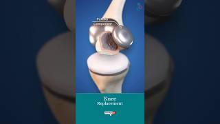 Knee Replacement Surgery ↪ 3D Medical Animation #Shorts #KneeReplacement #Knee