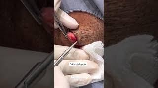 Dr Pimple Popper Makes it Look Easy
