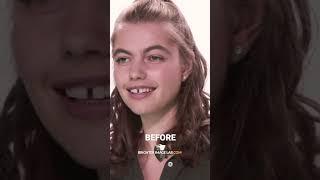 IncrediBIL Smile Makeover #shorts