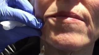 Juvederm Injection into Marionette Lines