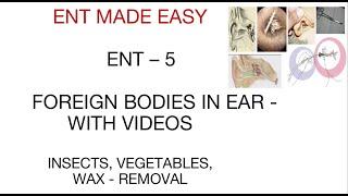 FOREIGN BODIES IN EAR - ENT 5 - ENT MADE EASY - WAX, INSECT IN EAR - WITH VIDEOS - USMLE PLAB FMGE.