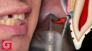 HOW TO Prep ANTERIOR Teeth with a MISSING Lateral