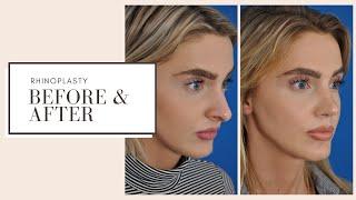 Plastic Surgery Before & After | Rhinoplasty (Nose Job) | ESKMD NYC