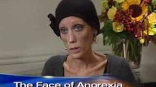 Anorexia's Living Face (CBS News)