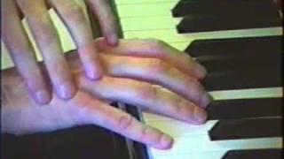 Introduction to musician's hand dystonia