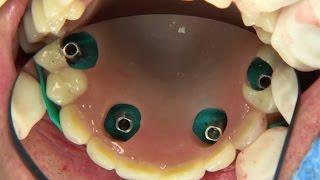 All-on-4® treatment concept clinical case: surgical procedure and denture conversion | Nobel Biocare