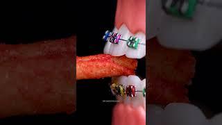 Oddly Satisfying Braces Bite Closeup – Relaxing Macro ASMR