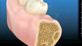 Dental Implant Animation - Step By Step Procedure