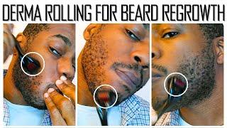 Microneedling for Beard Growth  - 30 Day Results