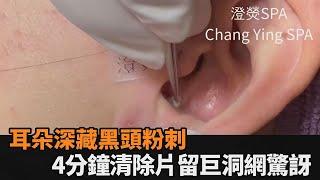 耳內深藏黑頭粉刺！4分鐘「清除紀錄」留巨洞　網驚：都不用洗耳朵？－全民話燒