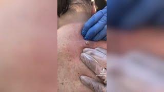 Popping huge blackheads and Giant Pimples - Best Pimple Popping Videos #127