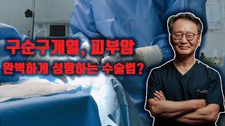구순구개열, 피부암 재건성형으로 완벽하게 수술하는 방법은? 예후 나쁜 악성흑색종 진단법은?