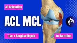 ACL (Anterior Cruciate Ligament) MCL (Medial Collateral Ligament) Tear and Repair (No Narration)