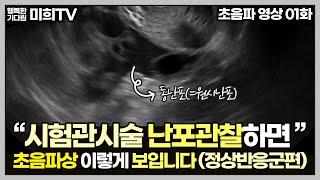시험관 시술받으러 가면 초음파를 보던데 난포가 뭐고 날짜에 따라 어떻게 자라나요?