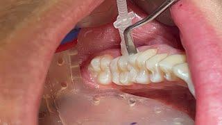 NEW Proximal Curodont Tutorial Hydroxyapatite Remineralization Minimally Invasive Cavity Prevention