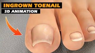 Ingrown Toenail Removal | 3D Animation