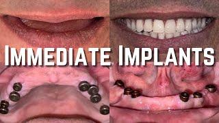 Full Mouth Dental Implant Teeth Restoration India | Implant dentist in Jalandhar | Cost of Implants