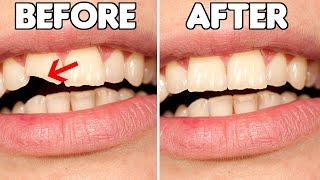 How To FIX A Chipped Tooth (Broken Tooth Repair Options)