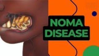 Understanding Noma: Its Causes, Symptoms, and Treatment - A Comprehensive Health Education Guide