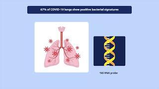 COVID-19 Lung Disease Leads to Blockage of Bronchi from Excess Mucus Build-up