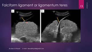 lecture 2 Liver Part B Liver Ultrasound Capsule , ligaments , catheters , vasculature and others