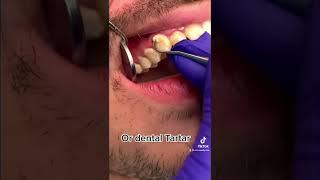 Dental cleaning, scaling #dentist #tiktok #video #viral #trending #shorts #youtubeshorts #youtube