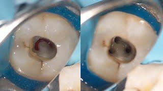 Root Canal Treatment of Mandibular Second Molar