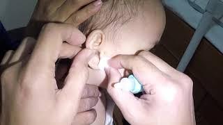 Removing A Chunk of Pencil Lead Stuck in Girl's Ear