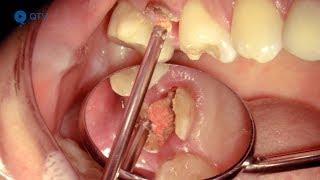 Sofortimplantation in Oberkiefer-Molaren-Extraktionsalveole (aus „Dental Video Journal“ 1/2018)