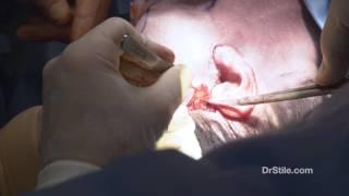 Dr. Stile - Midface Lift Surgery Part 2