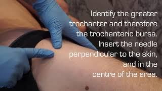 Injection Technique of the Trochanteric Bursa for Bursitis