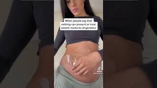 Clinically proven stretch mark treatment ️