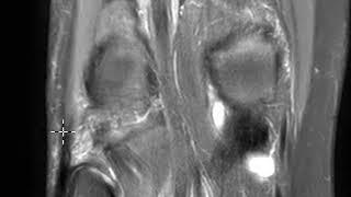 Popliteus tendon tear