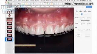 Керамические виниры. Цифровой дизайн улыбки. (DSD- digital smile design)