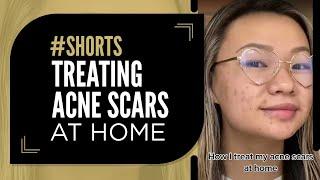 Treating Acne Scars at Home #acnescars