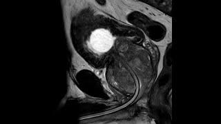 HoLEP in a patient in urinary retention with metastatic prostate cancer  (T3bM1b, 168g prostate)