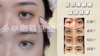 告別黑眼圈2.0！你知道自己是哪種類型的黑眼圈嗎？ // 心蒂急診室S3｜CindyH