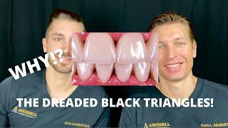 BLACK TRIANGLES BETWEEN TEETH! WHY??