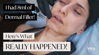 Full Face Dermal Filler!  Here's what REALLY happened! (2021)