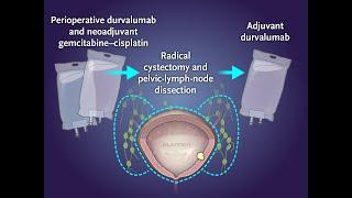 Perioperative Durvalumab in Bladder Cancer | NEJM