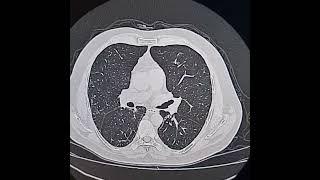 Sequele of COVID-19 pneumonia.