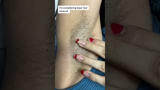 Permanent hair removal solution. #beauty #skincare #shorts