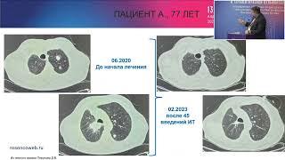Сложный клинический случай лечения рака легкого