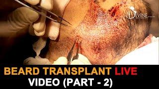 Beard Transplant Live Video Part 2 | Beard Hair Transplant Cost | Plastic Surgery in India