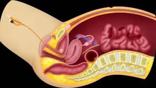 Complications of laparoscopic surgery