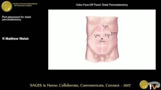 Port placement for distal pancreatectomy